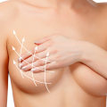 Breast Augmentation: Enhancing Your Body Shape in Los Angeles