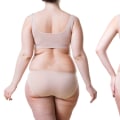 Exploring the Benefits of Liposuction in Los Angeles