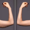 Everything You Need to Know About Arm Liposuction