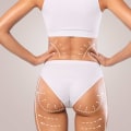 The Brazilian Butt Lift: A Comprehensive Guide to Body Contouring in Los Angeles