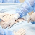 Preparing for a Liposuction Procedure: What You Need to Know