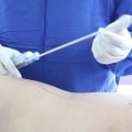 Stopping Smoking and Alcohol Consumption Before a Liposuction Procedure