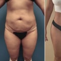 Liposuction and Mommy Makeover: Improving Your Body Shape in Los Angeles