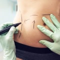 Choosing a Qualified Surgeon for Your Liposuction Procedure