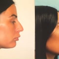 Understanding Rhinoplasty: A Guide to Improving Your Nose