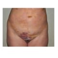 Understanding Bleeding and Bruising in Liposuction