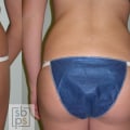 Communicating with the Surgeon: What You Need to Know About Liposuction in Los Angeles