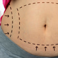 Arranging Transportation and Aftercare for Your Liposuction Procedure