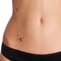 Exploring Radiofrequency-Assisted Liposuction (RFAL): The Minimally Invasive Liposuction Option for a Better Body Shape