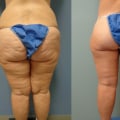 Thigh Liposuction: Achieving Your Dream Body in Los Angeles