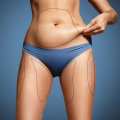 Laser-assisted Liposuction (LAL): Improving Your Body Shape in Los Angeles