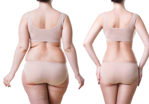 Exploring the Benefits of Liposuction in Los Angeles