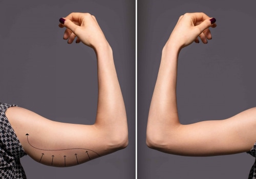 Everything You Need to Know About Arm Liposuction