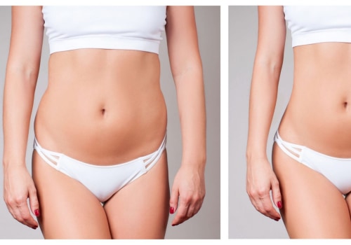 Water-assisted Liposuction: A Minimally Invasive Option for Body Contouring in Los Angeles