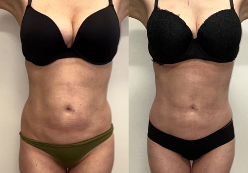 Maintaining a Healthy Diet and Exercise for Liposuction Recovery in Los Angeles