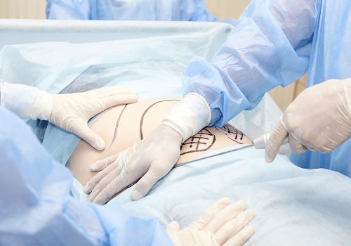 Preparing for a Liposuction Procedure: What You Need to Know