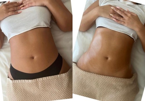 Understanding Ultrasound Lipolysis: The Non-Surgical Alternative to Liposuction