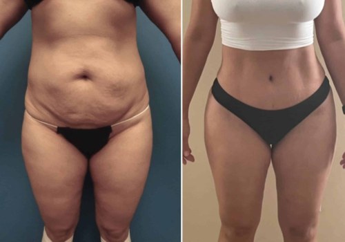 Liposuction and Mommy Makeover: Improving Your Body Shape in Los Angeles