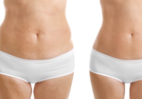 Understanding Ultrasound-Assisted Liposuction (UAL)