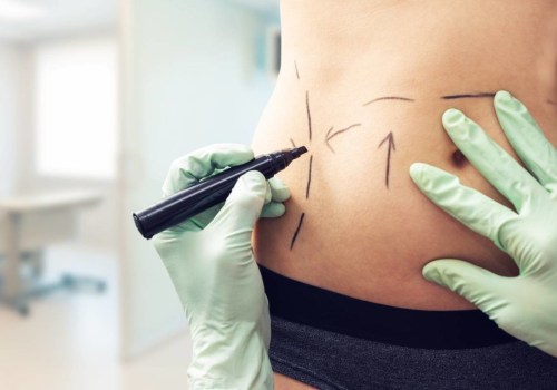 Choosing a Qualified Surgeon for Your Liposuction Procedure