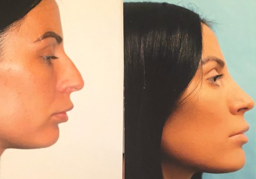 Understanding Rhinoplasty: A Guide to Improving Your Nose