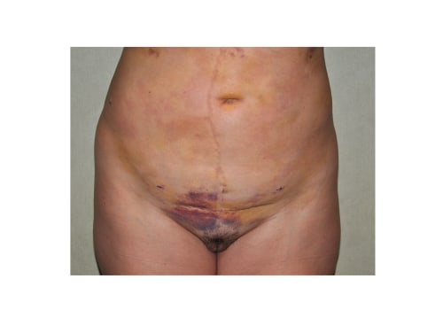 Understanding Bleeding and Bruising in Liposuction