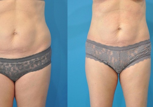 Understanding Limitations of Liposuction: What You Need to Know Before Considering the Procedure