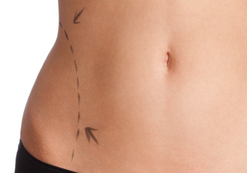 Exploring Radiofrequency-Assisted Liposuction (RFAL): The Minimally Invasive Liposuction Option for a Better Body Shape