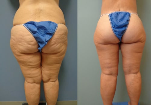 Thigh Liposuction: Achieving Your Dream Body in Los Angeles