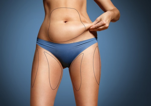 Laser-assisted Liposuction (LAL): Improving Your Body Shape in Los Angeles